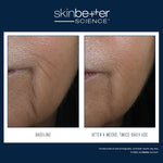 Skinbetter Science InterFuse Intensive Treatment LINES clinical before and after