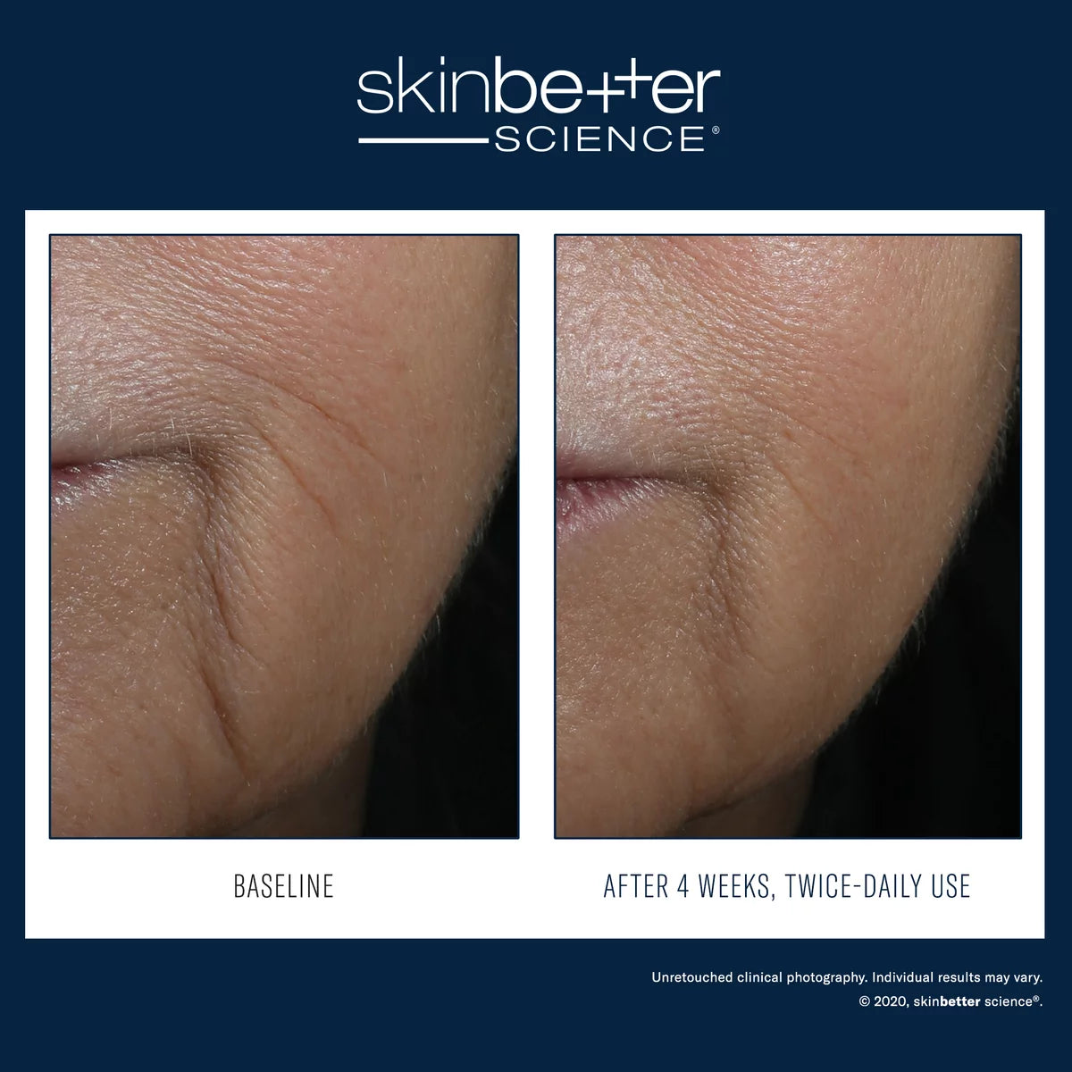 Skinbetter Science InterFuse Intensive Treatment LINES clinical before and after